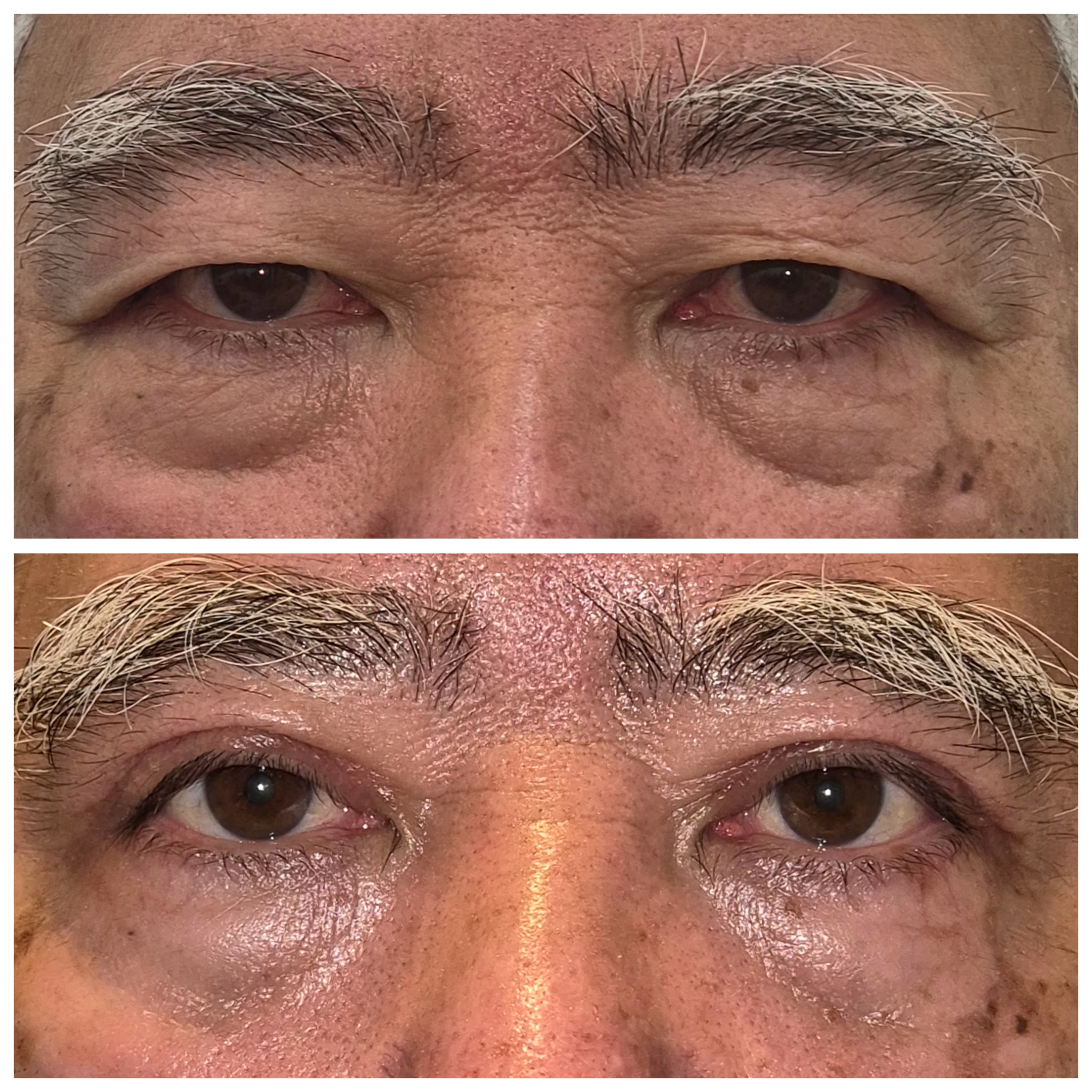 Antes e depois de blefaroplastia 6